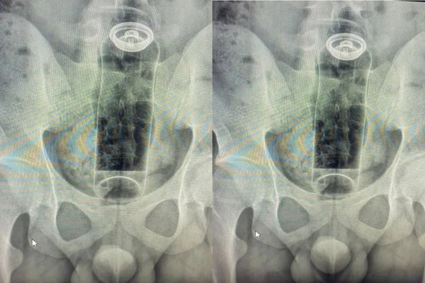 Jovem de 19 anos internado após desodorante ficar preso no reto