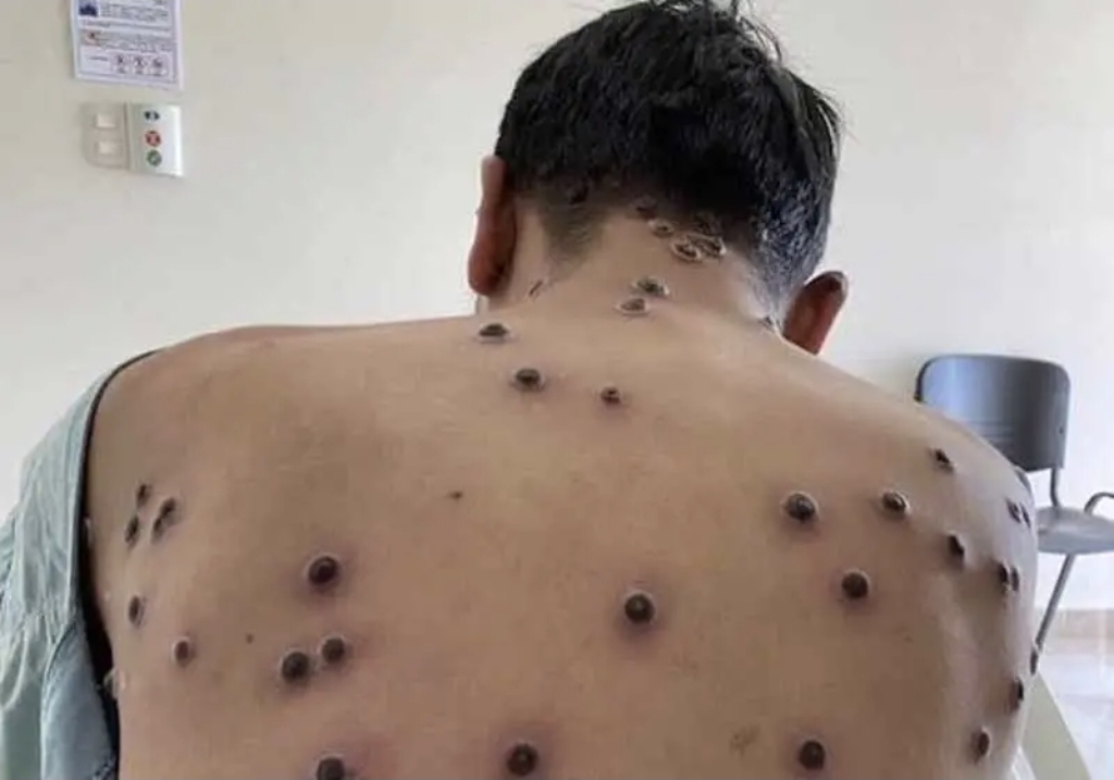 Novo caso de MPOX é confirmado em Porto Alegre e alerta foliões para o Carnaval