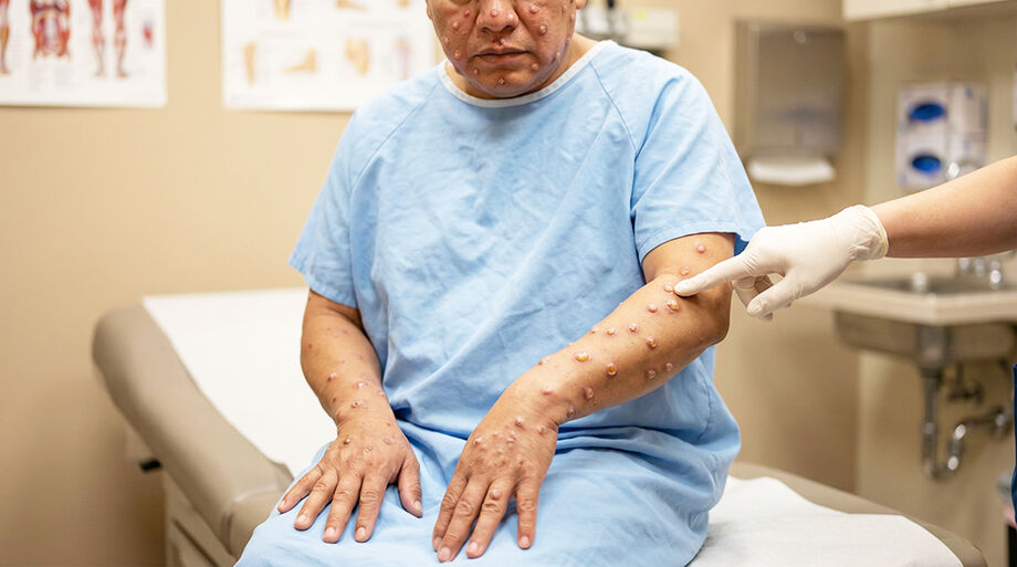 Ministério da Saúde alerta para chegada de nova variante de mpox no Brasil