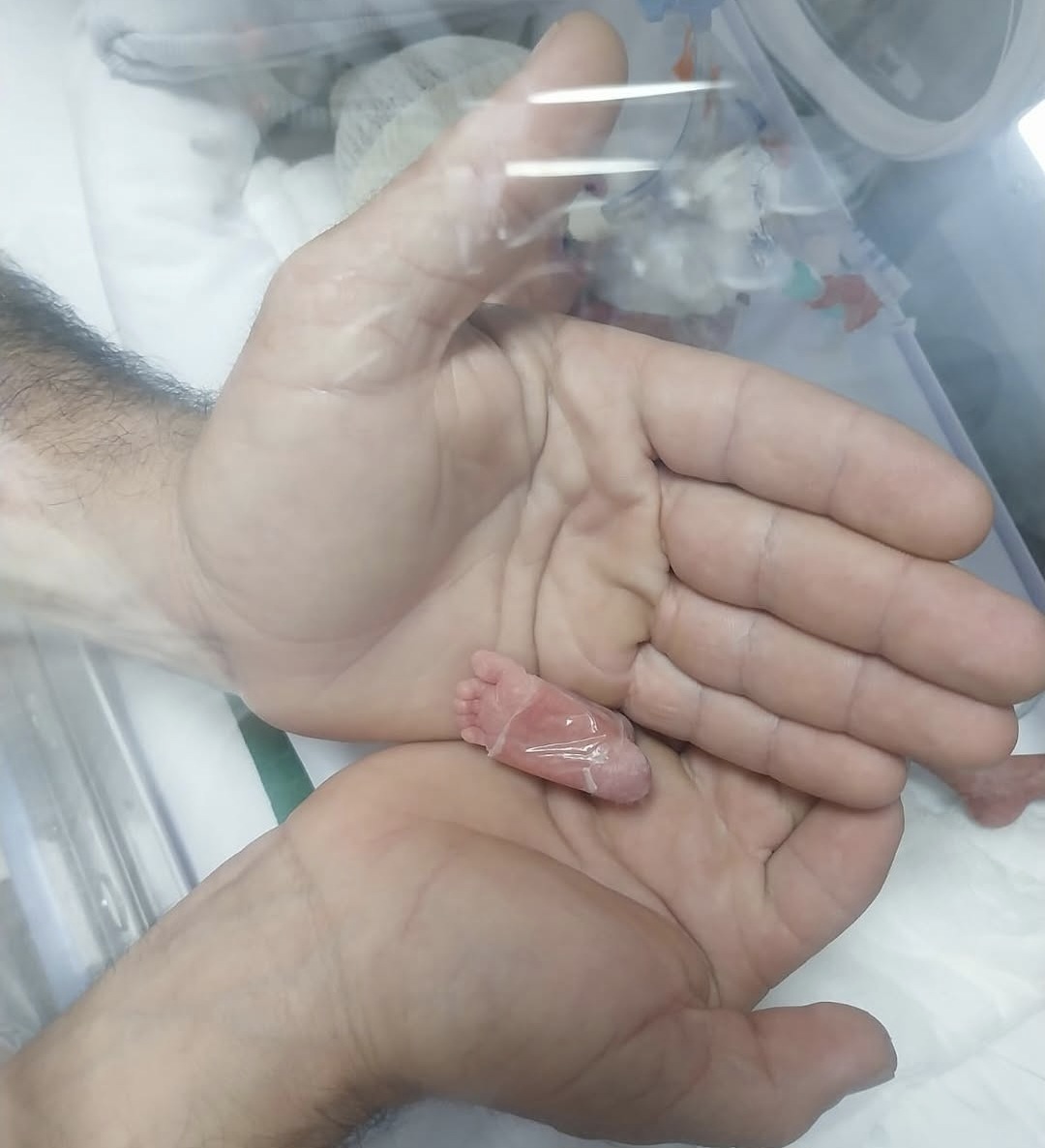 Bebê prematura extrema com 1% de chance de sobrevivência é batizada em Aparecida após 81 dias na UTI